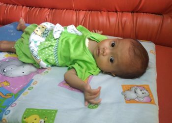 penderita gizi buruk